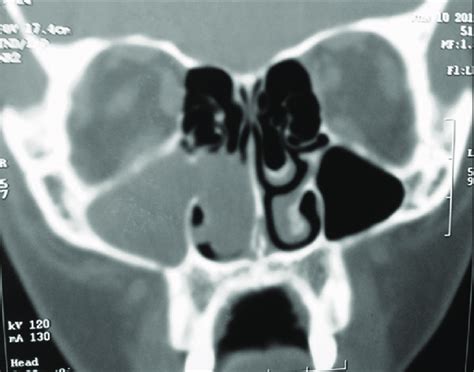 Imaging the Paranasal Sinuses and Nasal Cavity .